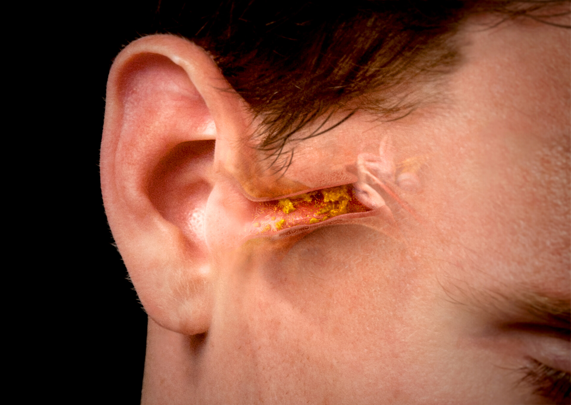 Earwax build-up in ear