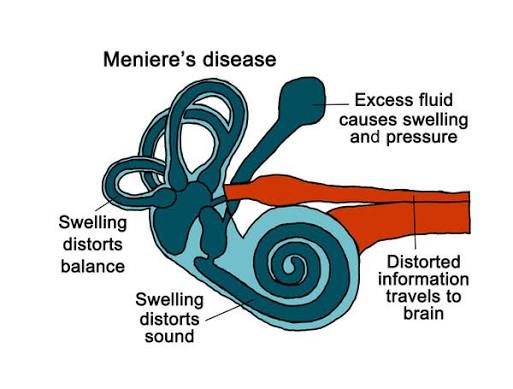 Managing Ménière’s Disease: How Professional Earwax Removal Can Help